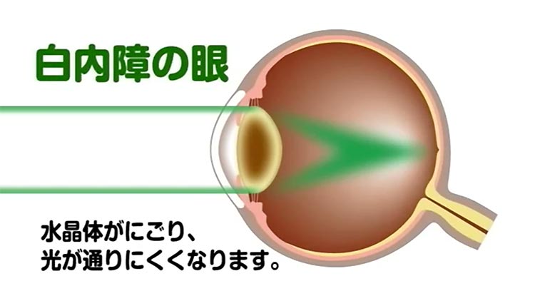 白内障の眼