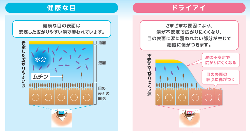 ドライアイの原因と治療について｜西川口の森田眼科