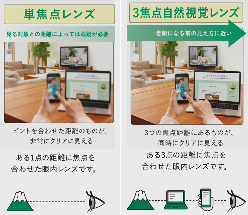 単焦点・多焦点・トーリック眼内レンズの違いを示す比較図|川口市の森田眼科