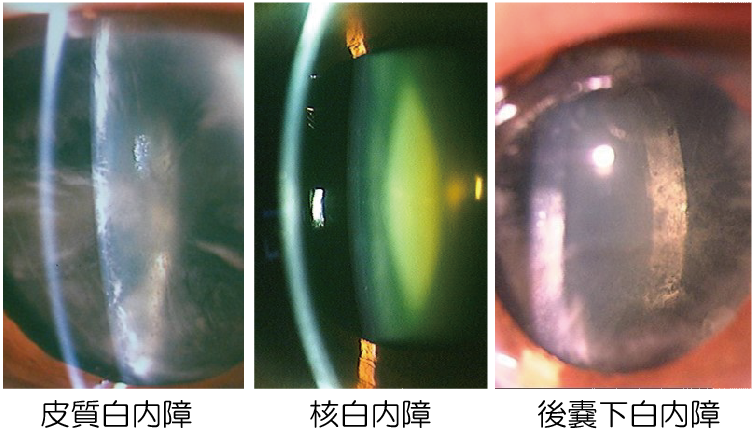 白内障の種類(写真)|川口市西川口駅の森田眼科(専門医が解説)