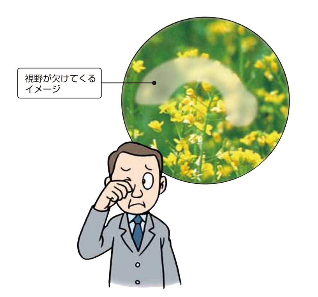 視神経乳頭陥凹拡大の原因である緑内障のイラスト|川口市・森田眼科