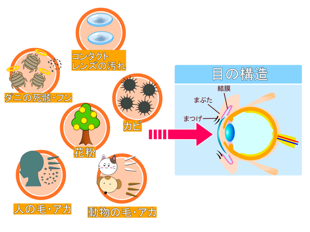 眼科専門医によるアレルギー性結膜炎の説明イラスト｜森田眼科（西川口駅）