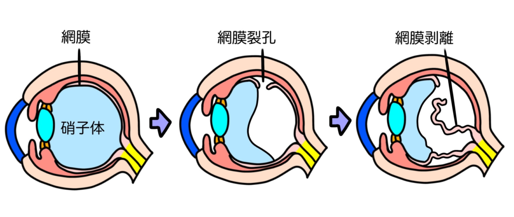  網膜剥離の仕組みイラスト｜急な視力低下・黒い影の原因｜川口市・森田眼科