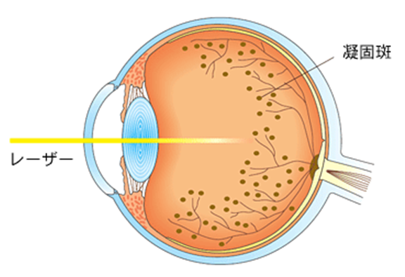 眼底レーザーのイラスト。蕨市からもアクセス良好な森田眼科で実施。