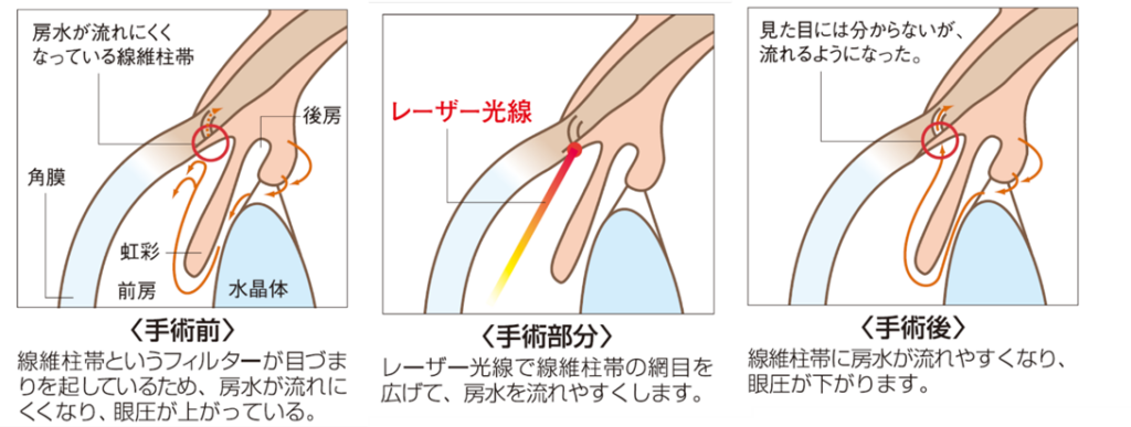緑内障レーザー（選択的レーザー線維柱帯形成術：SLT）の実際の手順のイラスト。森田眼科副院長が編集、解説。