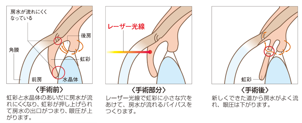 緑内障レーザー（レーザー虹彩切開術：LI）の実際の手順のイラスト。森田眼科副院長が編集、解説。