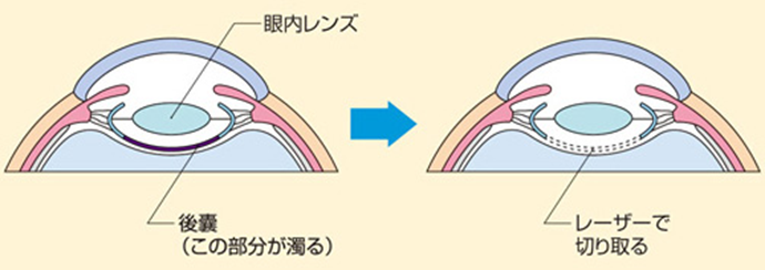 後発白内障に対するレーザー治療のイラスト。川口市の森田眼科で実施。