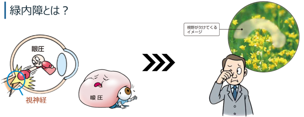 緑内障の概念図。目から脳へ情報を伝える視神経が障害され、見える範囲（視野）が徐々に欠けていく様子を示しています。川口市の眼科・森田眼科が解説。