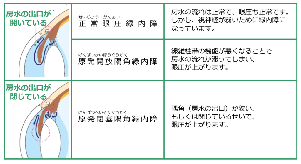 原発緑内障の分類｜森田眼科（西川口駅）副院長：森田修（眼科専門医・医学博士）が作成