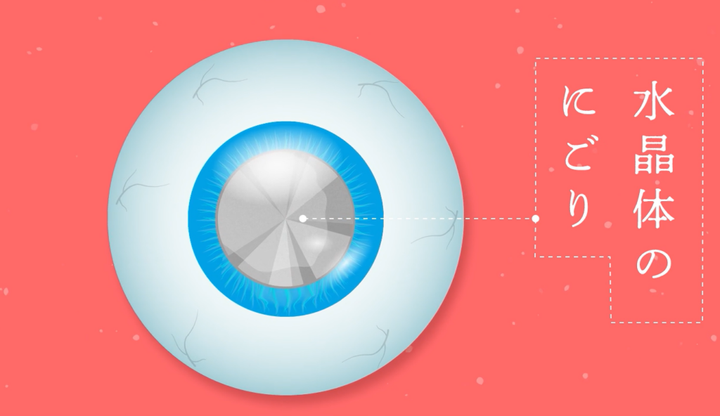 白内障のイメージ図。川口市森田眼科｜日帰り白内障手術に対応。